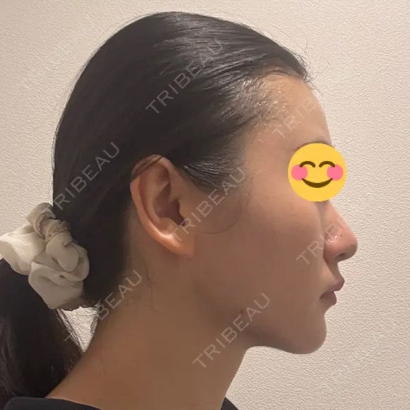 脂肪吸引（顔） / ヒアルロン酸注入（あご） HAAB×DREAM BEAUTY CLINIC 東京本院 AFTER メイン用