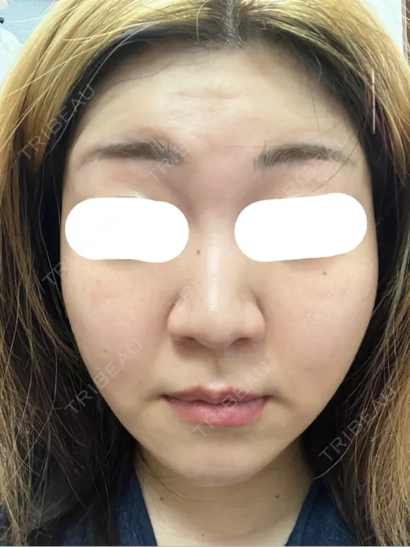 ボトックス（あご） / ボトックス（口角） / ボトックス（額） 東京美容医療クリニック 池袋院 DAY 0 メイン用