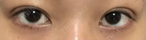 二重埋没 恵聖会クリニック 京橋院 DAY 1 メイン用