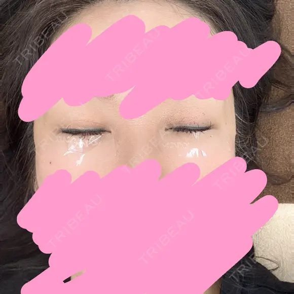 ヒアルロン酸注入（涙袋） AZ BEAUTY CLINIC DAY 0 メイン用