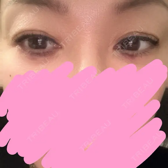 ヒアルロン酸注入（涙袋） AZ BEAUTY CLINIC DAY 0 メイン用