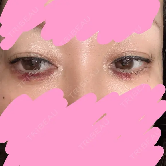 ヒアルロン酸注入（涙袋） AZ BEAUTY CLINIC DAY 0 メイン用