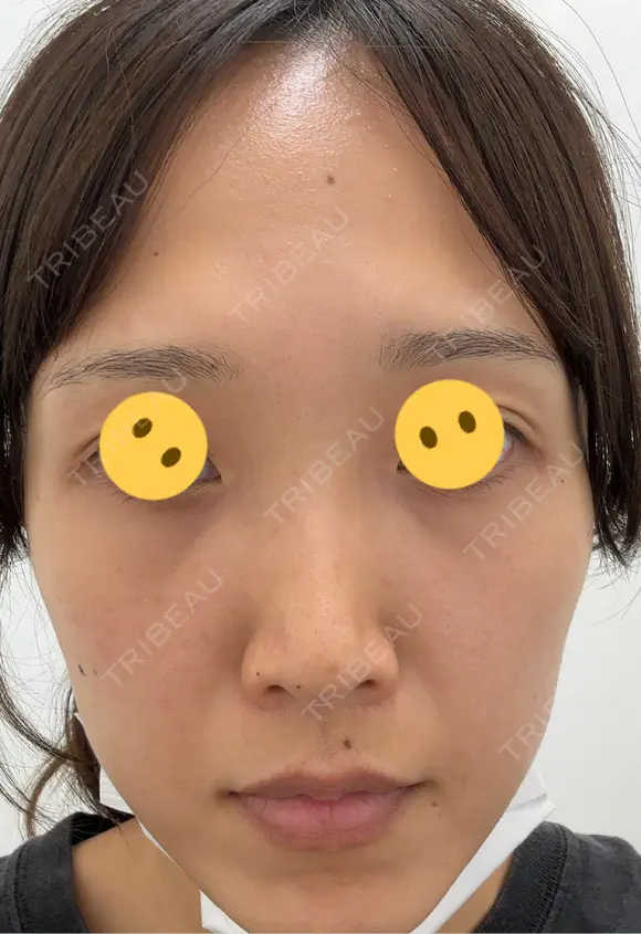 毛穴洗浄（ハイドラフェイシャルなど） / ピコレーザートーニング（美白・肝斑） CIEL SKIN CLINIC（シエルスキンクリニック） AFTER メイン用