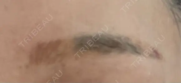 アートメイク除去・修正 渋谷美容外科クリニック 新宿院 AFTER メイン用