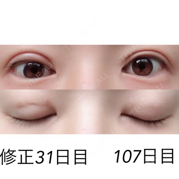 二重埋没 / 目元修正 湘南美容クリニック 広島院 DAY 31 メイン用