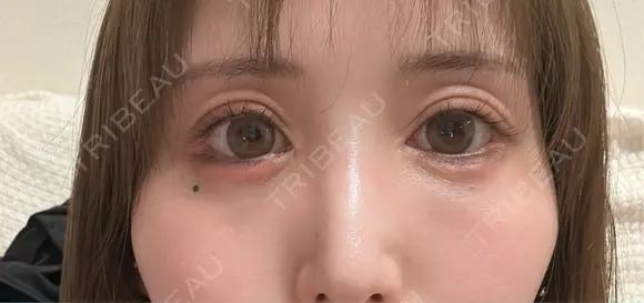 脂肪注入（目の下） アネシス美容クリニック DAY 13 メイン用