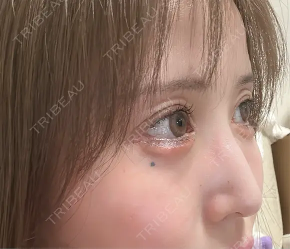 脂肪注入（目の下） アネシス美容クリニック DAY 13 メイン用