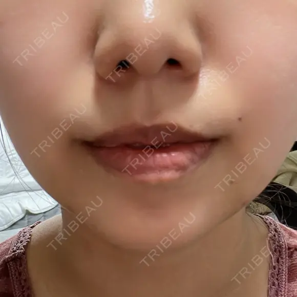 脂肪吸引（顔） ネビュラクリニック 京都院 AFTER メイン用