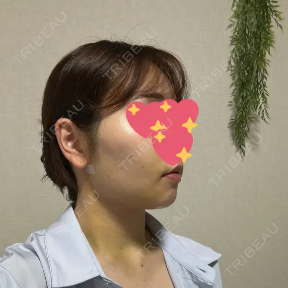 糸リフト / 脂肪吸引（顔） 渋谷美容外科クリニック 渋谷院 DAY 24 メイン用