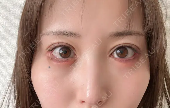 脂肪注入（目の下） アネシス美容クリニック DAY 14 メイン用