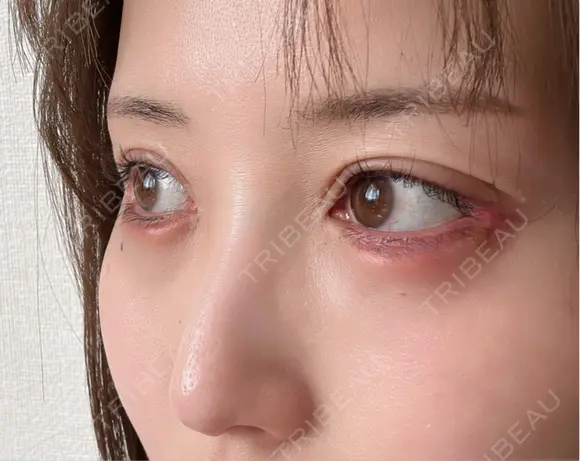 脂肪注入（目の下） アネシス美容クリニック DAY 14 メイン用