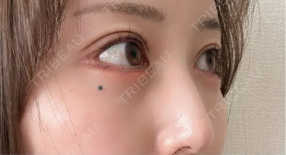 脂肪注入（目の下） アネシス美容クリニック DAY 14 メイン用