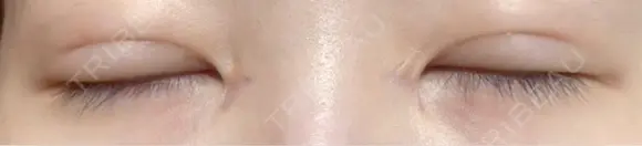 二重埋没 / 目頭切開 / 上まぶたの脂肪取り アリエル美容クリニック 郡山院 DAY 31 メイン用
