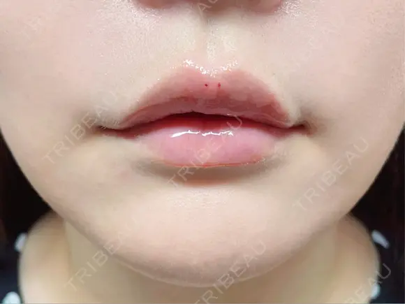 ヒアルロン酸注入（唇） 目白ホワイトクリニック DAY 0 メイン用