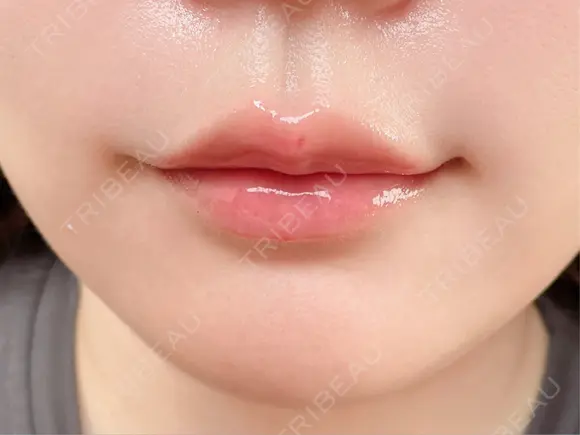 ヒアルロン酸注入（唇） 目白ホワイトクリニック DAY 1 メイン用