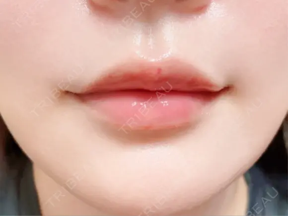 ヒアルロン酸注入（唇） 目白ホワイトクリニック DAY 2 メイン用