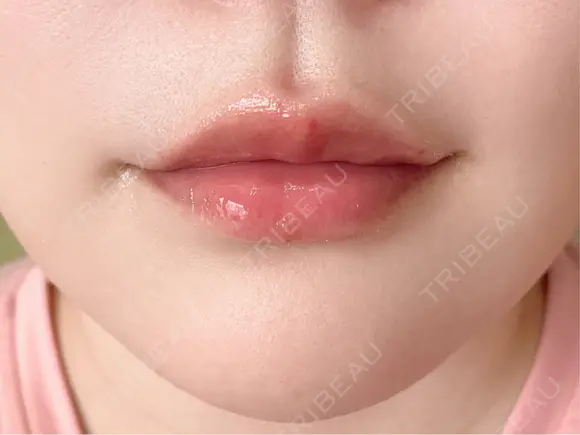 ヒアルロン酸注入（唇） 目白ホワイトクリニック DAY 5 メイン用