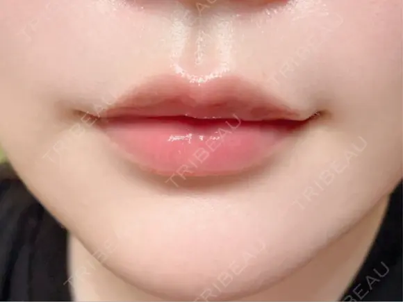 ヒアルロン酸注入（唇） 目白ホワイトクリニック AFTER メイン用