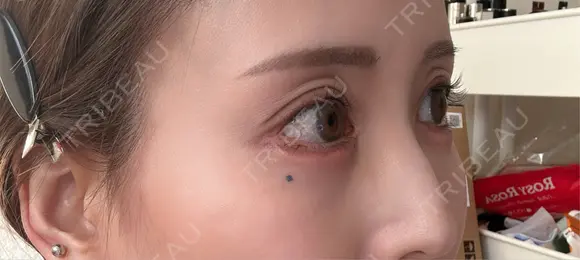 脂肪注入（目の下） アネシス美容クリニック DAY 15 メイン用