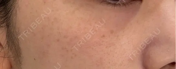 ルメッカ ルラ美容クリニック 上野院 DAY 0 メイン用