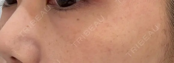 ルメッカ ルラ美容クリニック 上野院 DAY 0 メイン用