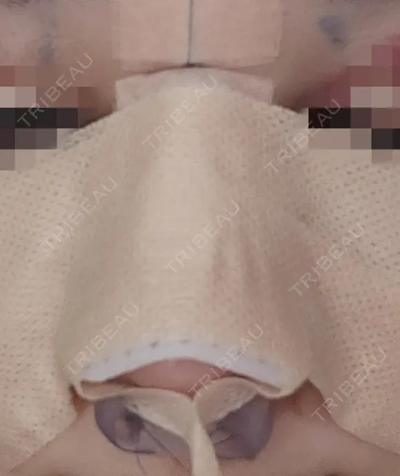 隆鼻術 / 鼻尖形成（切開） / 鼻中隔延長（切開） / その他（輪郭） リッツ美容外科 東京院 DAY 1 メイン用