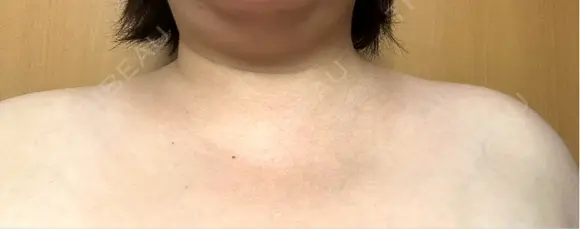 ボトックス（肩） アリエル美容クリニック 横浜院 DAY 15 メイン用