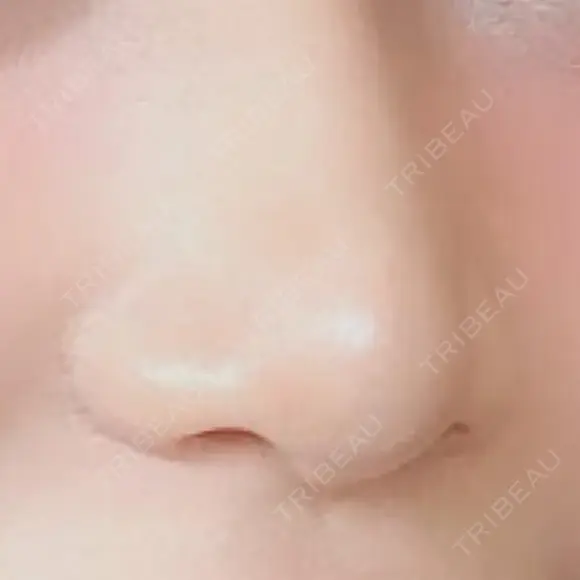 鼻尖形成（切開） / 軟骨移植 / ボトックス（あご） 北尾クリニック AFTER メイン用