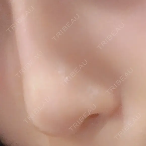 鼻尖形成（切開） / 軟骨移植 / ボトックス（あご） 北尾クリニック DAY 157 メイン用