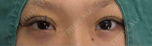 二重埋没 ネビュラクリニック 京都院 AFTER メイン用