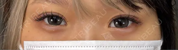 二重埋没 ネビュラクリニック 京都院 DAY 0 メイン用