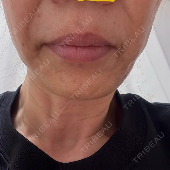 その他（肌） / RF（高周波）たるみ治療 ルラ美容クリニック 札幌本院 DAY 0 メイン用