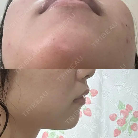 ボトックス（あご） / ヒアルロン酸注入（あご） TCB東京中央美容外科 梅田茶屋町院 AFTER メイン用