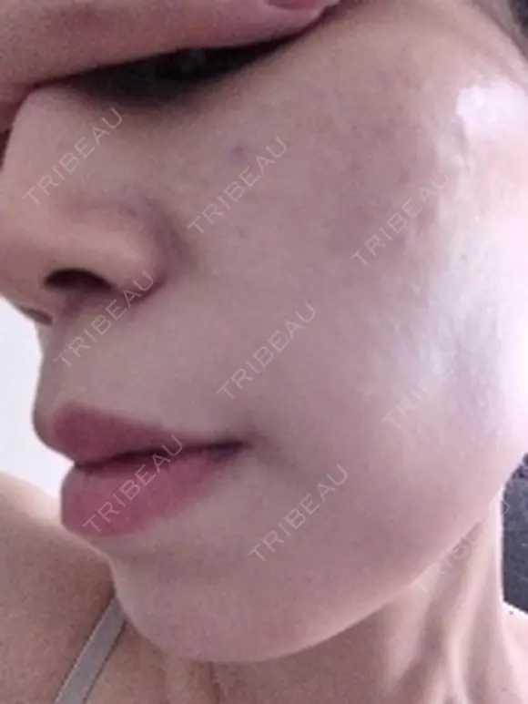 リジュラン ワンストップヘアクリニック 大阪院 AFTER メイン用