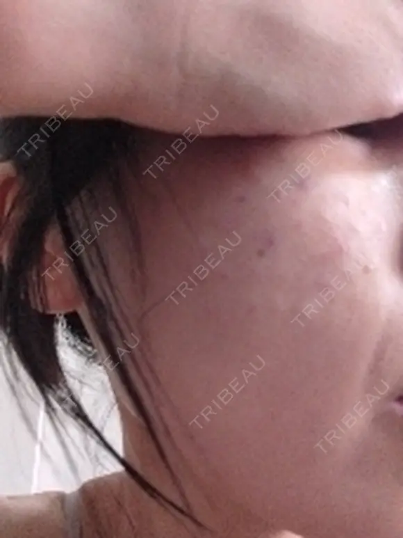 リジュラン ワンストップヘアクリニック 大阪院 DAY 0 メイン用