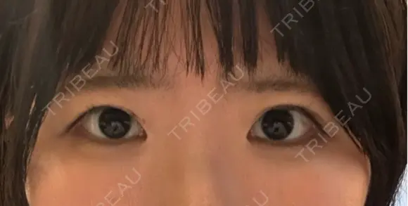 二重切開 聖心美容クリニック 広島院 AFTER メイン用