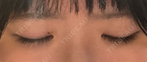 二重切開 聖心美容クリニック 広島院 DAY 146 メイン用