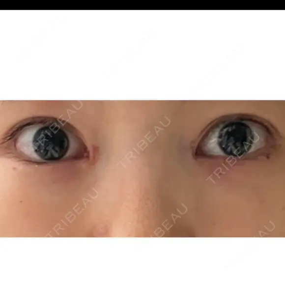 目頭切開 ネビュラクリニック 京都院 DAY 17 メイン用