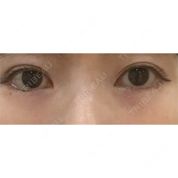 目頭切開 ネビュラクリニック 京都院 DAY 137 メイン用