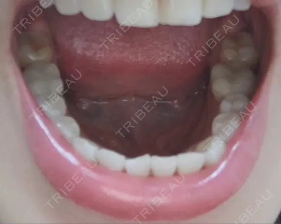 セラミック 東京美容外科 赤坂院 AFTER メイン用