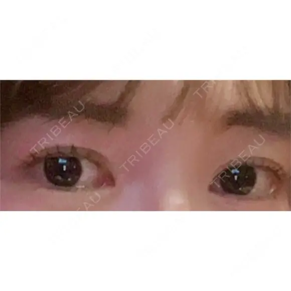 目頭切開 ネビュラクリニック 京都院 DAY 46 メイン用