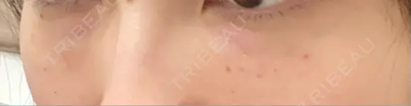 肌ヒアルロン酸注入（たるみ・シワ改善） しのぶ皮膚科 DAY 1 メイン用