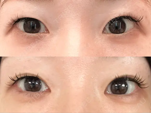 目尻切開 / タレ目形成・グラマラスライン（切開） / タレ目形成・グラマラスライン（埋没） A CLINIC（エークリニック） 大阪院 DAY 20 メイン用