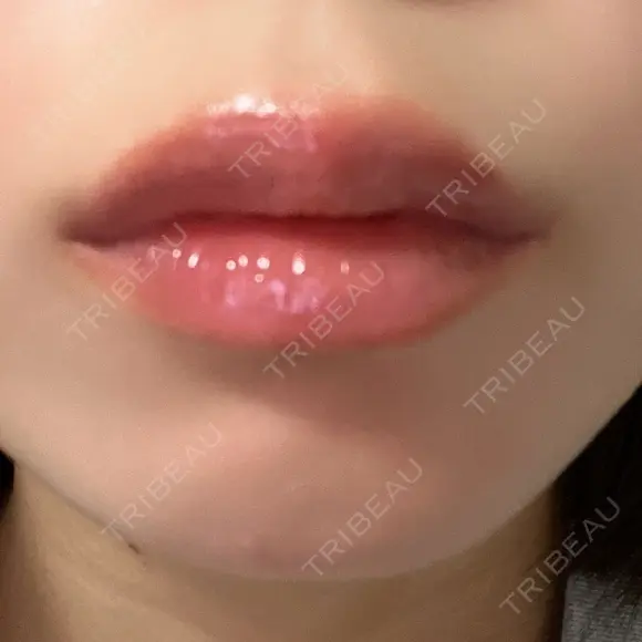 ヒアルロン酸注入（唇） 目白ホワイトクリニック DAY 1 メイン用