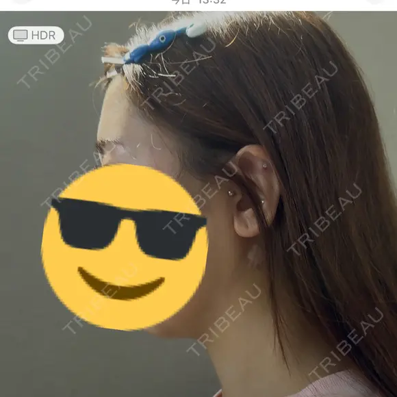 糸リフト / 脂肪吸引（顔） / ジョールファット除去 RIVER CLINIC（リバークリニック） DAY 2 メイン用