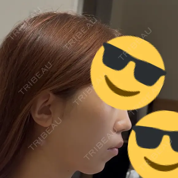 糸リフト / 脂肪吸引（顔） / ジョールファット除去 RIVER CLINIC（リバークリニック） DAY 2 メイン用