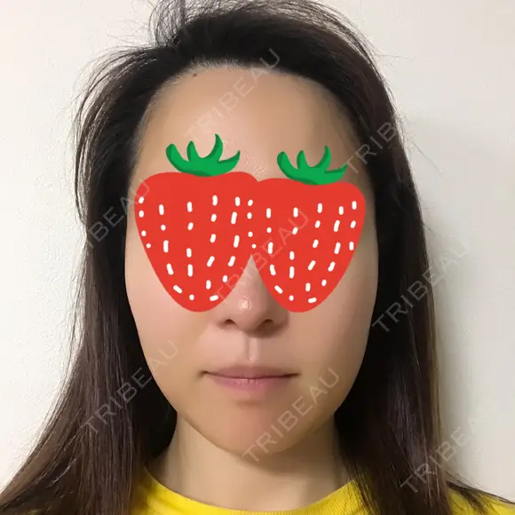 ボトックス（エラ・小顔） 湘南美容クリニック 京都院 DAY 14 メイン用