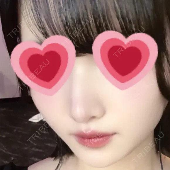 鼻尖形成（切開） / 小鼻縮小（切開） / 軟骨移植 / 鼻柱下降・鼻唇角形成（猫手術） / ボトックス（エラ・小顔） ASTRA BEAUTY CLINIC DAY 23 メイン用