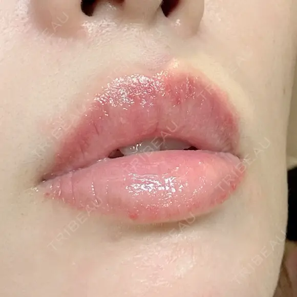 アートメイク（唇） 表参道メディカルクリニック 新宿院 AFTER メイン用