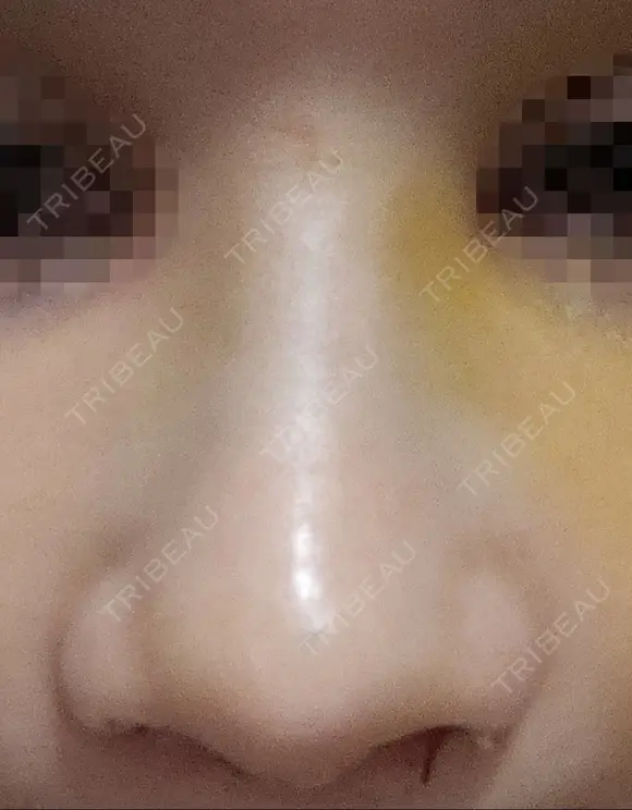 隆鼻術 / 鼻尖形成（切開） / 鼻中隔延長（切開） / その他（輪郭） リッツ美容外科 東京院 DAY 8 メイン用